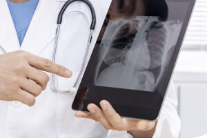 만성 폐쇄성 폐질환(COPD) 환자 산소 치료법